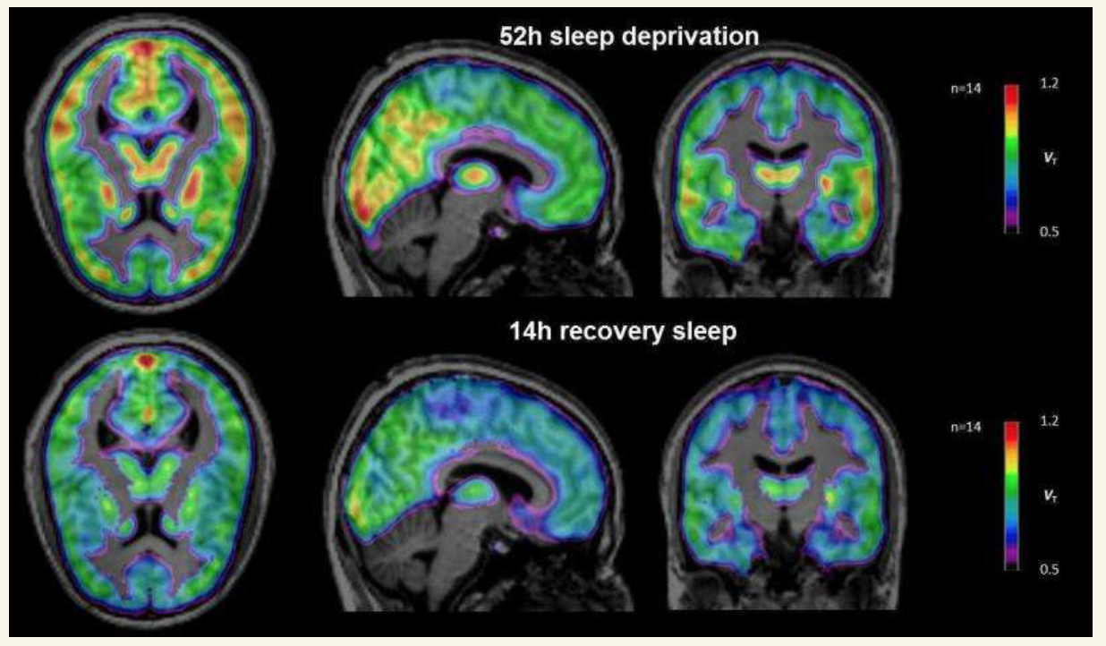 Sleeping brains. Сон и мозг. Sleeping Brain МРТЭ. Депривация сна. Депривация сна в психиатрии.